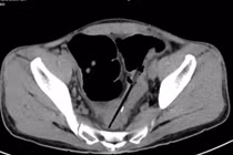 Người mắc hội chứng Pica thích ăn các đồ vật không phải thức ăn
