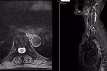 Phát hiện xẹp nhiều đốt sống do loãng xương nặng