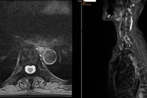 Phát hiện xẹp nhiều đốt sống do loãng xương nặng
