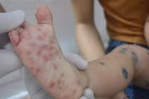 Hà Nội ghi nhận tăng ca bệnh tay chân miệng