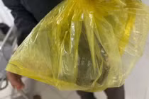 Con đỉa chui vào niệu đạo người đàn ông 75 tuổi