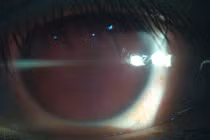 Nam thanh niên chấn thương mắt do nổ bóng đèn huỳnh quang