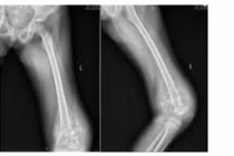 Phẫu thuật thay khớp gối cho bệnh nhi 10 tuổi mắc ung thư xương