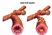Nhầm lẫn giữa bệnh hen và phổi tắc nghẽn nguy hiểm thế nào?