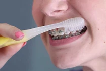 Khi niềng răng, vệ sinh răng miệng thế nào?