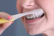 Cách chăm sóc răng miệng khi niềng răng