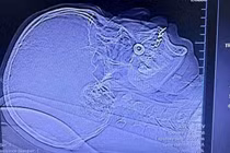 Nam thợ xây 54 tuổi ở Quảng Ninh bị đầu vít bắn xuyên vùng má 