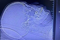 Nam thợ xây 54 tuổi ở Quảng Ninh bị đầu vít bắn xuyên vùng má 