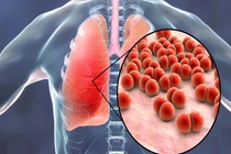 Cảnh báo mức độ nguy hiểm của nhiễm nấm phổi