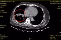 Người đàn ông ho ra máu nặng do giãn phế quản được cứu sống ngoạn mục