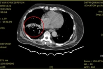 Người đàn ông ho ra máu nặng do giãn phế quản được cứu sống ngoạn mục