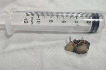 Gắp thành công 2 chiếc răng giả bỏ quên trong phổi bệnh nhân hơn 20 năm 