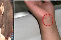 Bệnh nhi 16 tuổi mắc bệnh hiếm gặp từ chuột cắn