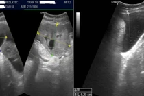 Người phụ nữ trẻ phát hiện ung thư buồng trứng từ triệu chứng chướng bụng 