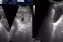 Người phụ nữ trẻ phát hiện ung thư buồng trứng từ triệu chứng chướng bụng 