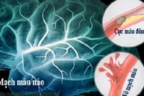 Thói quen phổ biến vào mùa lạnh làm tăng nguy cơ đột quỵ