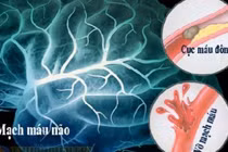 Thói quen phổ biến vào mùa lạnh làm tăng nguy cơ đột quỵ