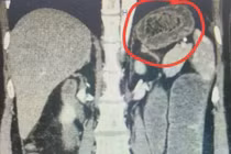 Nhập viện cấp cứu vì tắc ruột do bã thức ăn