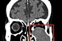 Người bệnh 76 tuổi bị khối u nhầy xoang hàm ăn mòn xương, ổ mắt