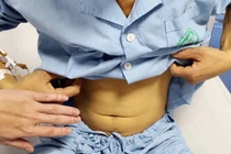 Uống mật cá trắm tăng sinh lý, người đàn ông ở Thanh Hóa bị ngộ độc nguy kịch