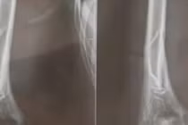 Chơi trò “vật tay”, nam thanh niên 18 tuổi bị gãy xương cánh tay phải