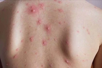 Thủy đậu ở người lớn bị biến chứng nặng do nhiễm trùng da