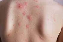 Thủy đậu ở người lớn bị biến chứng nặng do nhiễm trùng da