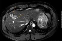 Người đàn ông 41 tuổi bị sán lá gan gây tổn thương nặng do hay ăn đồ sống