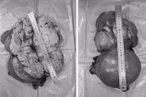 Bóc tách thành công khối u lớn nặng 8kg chiếm gần trọn ổ bụng người phụ nữ 