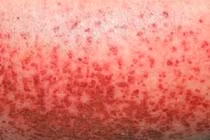 Tuần qua, Hà Nội ghi nhận 120 ca sốt xuất huyết tại 67 phường, xã 