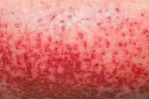 Tuần qua, Hà Nội ghi nhận 120 ca sốt xuất huyết tại 67 phường, xã 