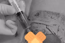 Bé trai 6 tuổi rơi vào nguy kịch khi va đập ở đầu gối