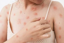 Thủy đậu gia tăng trong mùa đông xuân, phòng ngừa để tránh biến chứng nặng