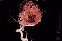 Cứu sống bệnh nhân 16 tuổi dị dạng mạch máu não 