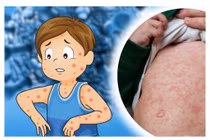 Điện Biên ghi nhận hơn 30 ca sởi