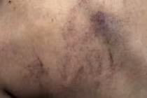 Cô giáo đã thừa nhận hành vi đánh bé gái 4 tuổi ở Hà Nội