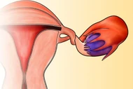 Xoắn phần phụ, cấp cứu phụ khoa nguy hiểm cần phát hiện sớm