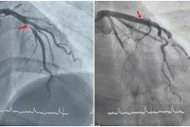 Bệnh nhân 29 tuổi phát hiện nhồi máu cơ tim qua điện tim trước nội soi