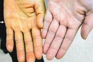 Viêm gan siêu vi B diễn tiến âm thầm, gây hậu quả nặng nề