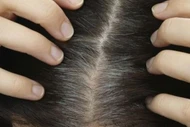 Nguyên nhân phổ biến gây tóc bạc sớm
