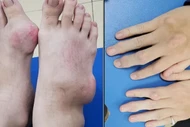 Nam thanh niên biến dạng tay chân nặng do biến chứng của bệnh gout