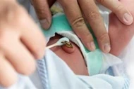Bé trai 10 ngày tuổi nguy kịch do gia đình dùng kéo không vô trùng cắt rốn