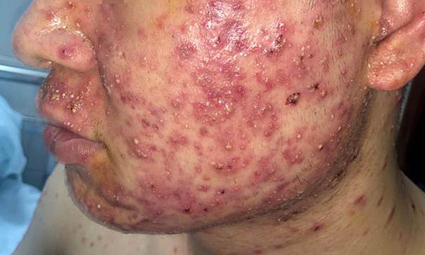 Xu hướng trị mụn không dùng thuốc năm 2025