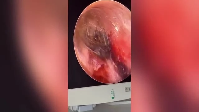 Video: Kinh dị cảnh nhện làm tổ, giăng tơ trong tai người đàn ông