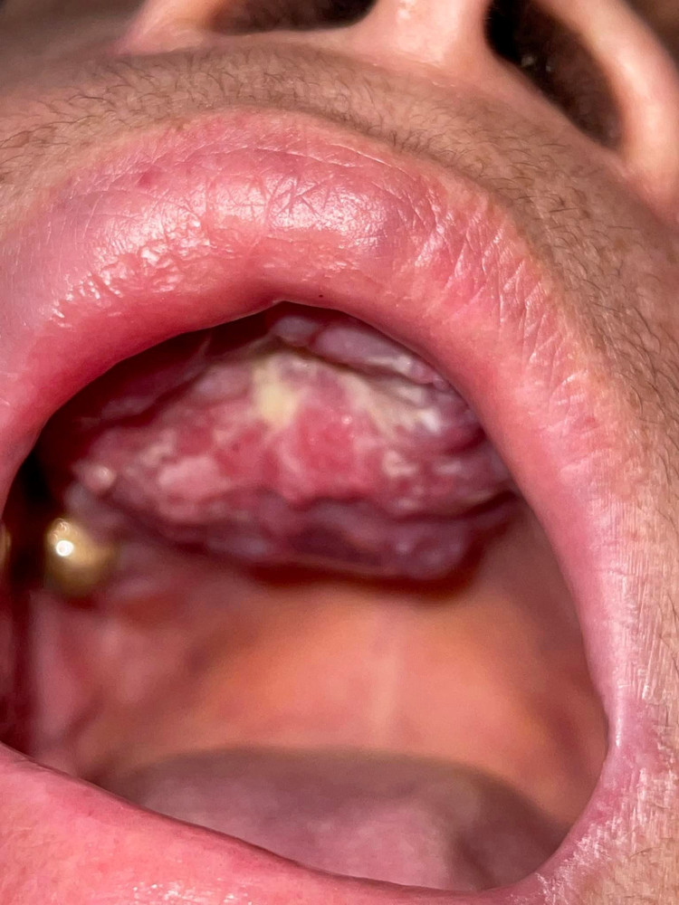 Khối u vòm khẩu cái của bệnh nhân khau-cai-2.jpg