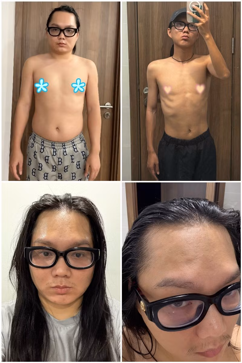 Dễ thấy, Phạm Thoại hiện tại sụt cân nhiều so với trước, lộ rõ xương sườn. Ngoài ra, nam TikToker còn gặp tình trạng rụng tóc.