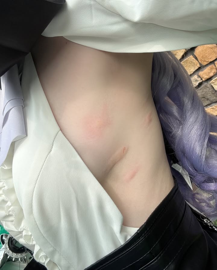 Tuy nhiên, bên cạnh sự chỉn chu từ nhan sắc cho tới công sức đầu tư vào trang phục, nhiều người cũng không khỏi "xót xa" khi phát hiện… dưới lớp áo của cô nàng là loạt vết muỗi đốt đỏ ửng, đặc biệt là ở vùng chân ngực và mạng sườn.