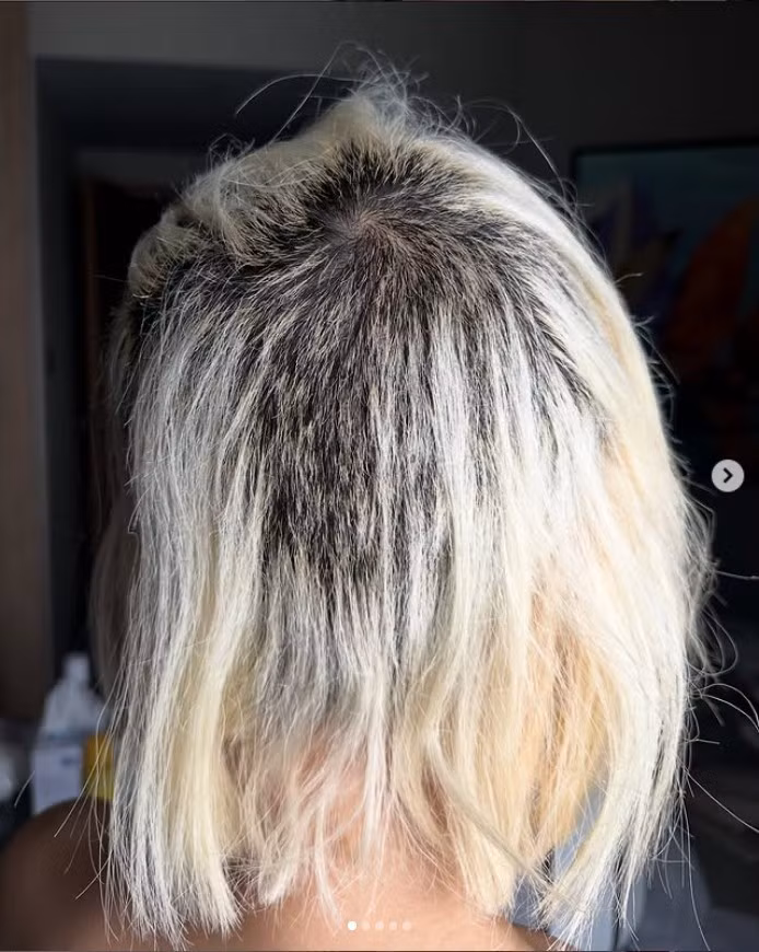 “Tóc tôi từng rất dày và khỏe, đến mức tôi chưa từng gặp ai có mái tóc dày hơn mình. Tôi không thể ngờ có ngày mình sẽ rụng gần hết tóc như thế này. Tôi rất buồn và đau lòng”, Soda bày tỏ.