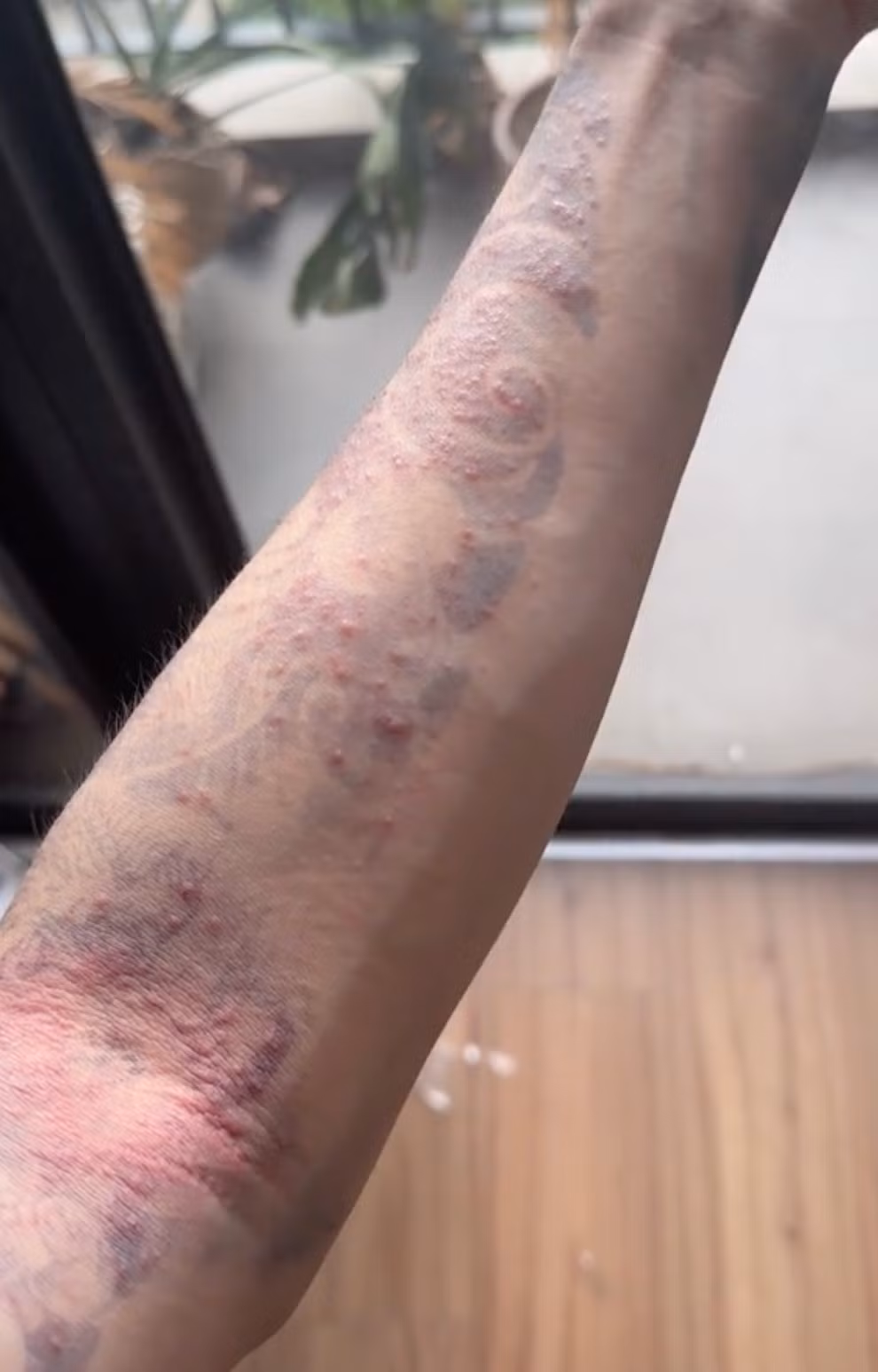 Trong clip, Huỳnh Khánh Đông mô tả các dấu mẩn đỏ đã lặn dần, song bị thâm da và mực vẫn chưa biến mất. Nam TikToker cho biết anh sợ hãi khi biết tình trạng dị ứng có thể để lại sẹo.