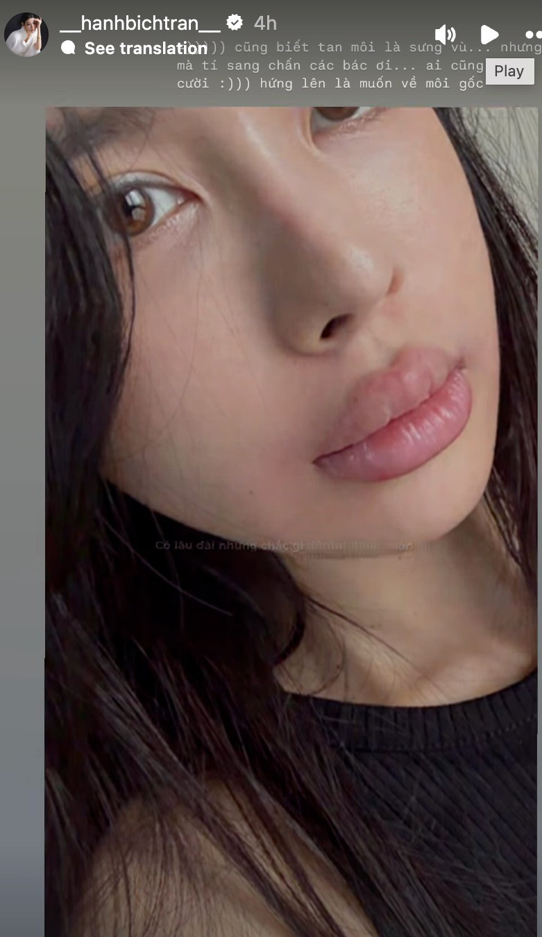 Theo đó, Bích Hạnh khoe bức ảnh đôi môi sưng vù do mới tiêm tan môi. Bạn gái cầu thủ Vũ Văn Thanh không ngại khoe việc đôi môi bị sưng cùng gương mặt mộc lên mạng xã hội.